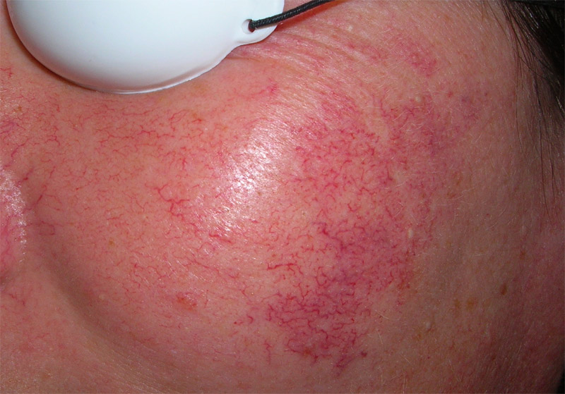 Hautnahpraxis Luzern Couperose Rosacea